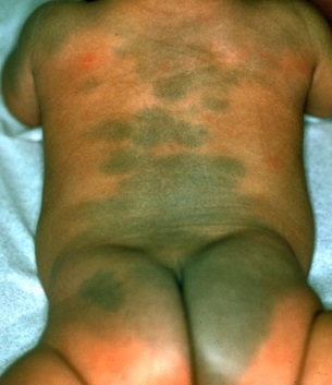 Mongolian Spots