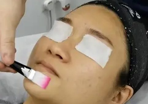 Chemical-Peel