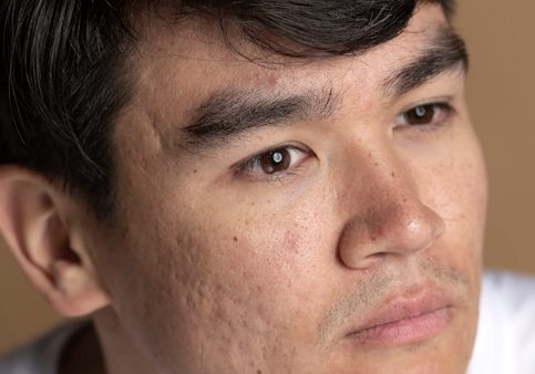 Pico-Laser-Treatment-For-Acne-Scars