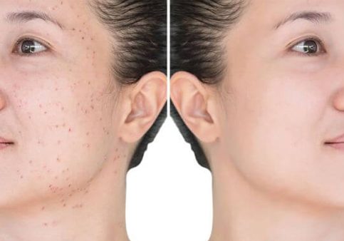 Pico-Laser-Treatment-For-Pigmentation