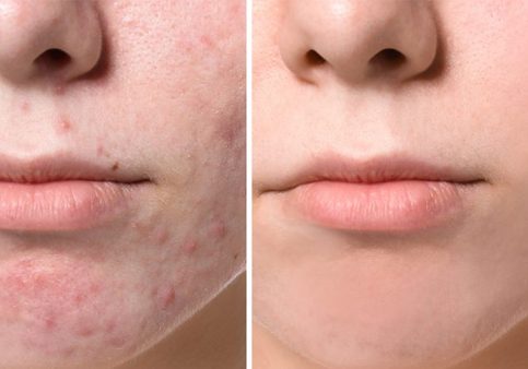 acne-is-mismanaged