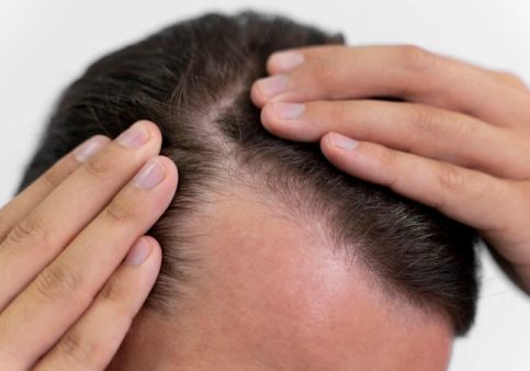 hair-loss
